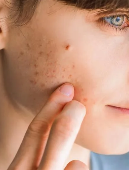 Acne For Teens – Services | Red Lotus Spa Abbotsford